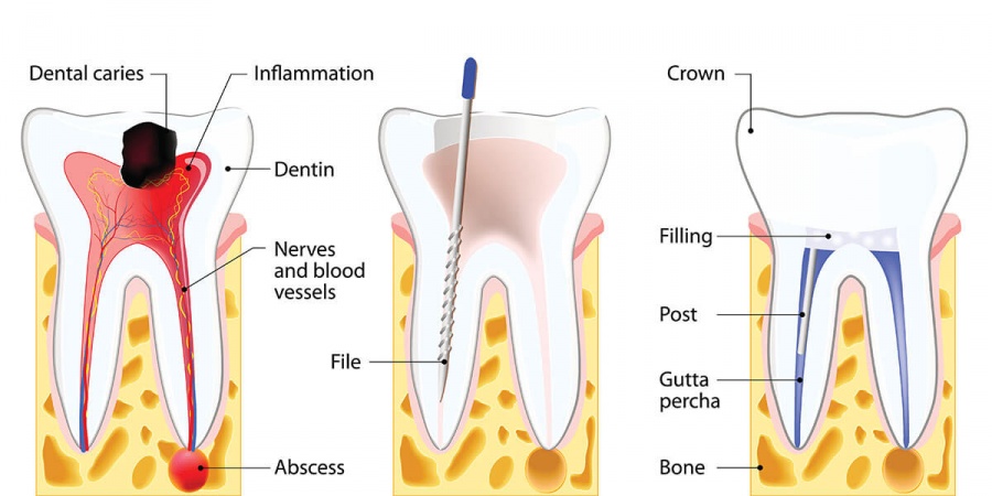 root-canal-treatment-hartsdale-scarsdale