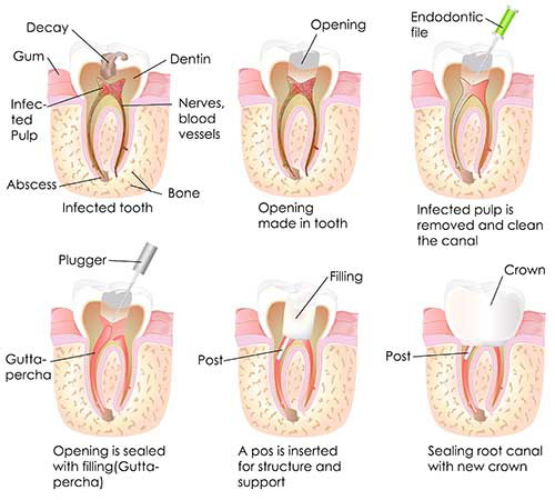 root-canal-treatment-westchester