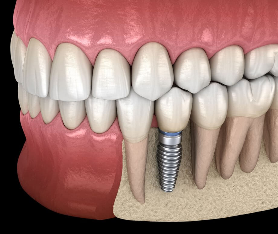 dental-implants-westchester